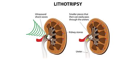 Lithotripsy: Meaning, Procedure and Benefits| Best Treatment for Kidney ...