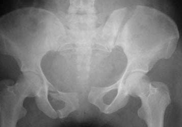 Avulsion Fracture Hip Iliac Crest