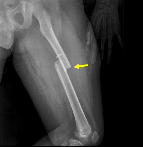 does leg get shorter after femur fracture pictures