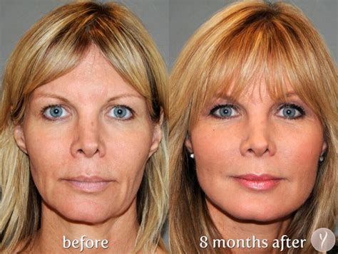 Facelift Surgery: 5 Useful and Significant facts