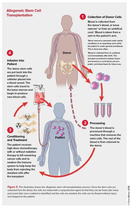 Physiotherapy in Stem Cell Transplantation - Physiopedia