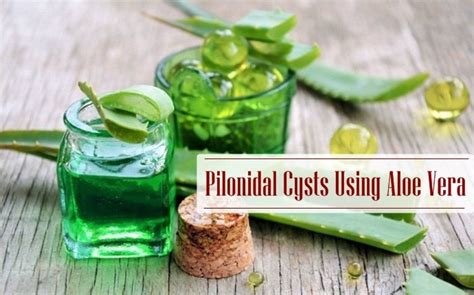 Top 15 Home Remedies For Pilonidal Cysts