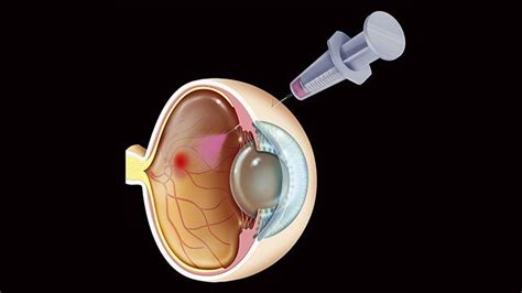 Treating Diabetic Macular Edema | Everyday Health