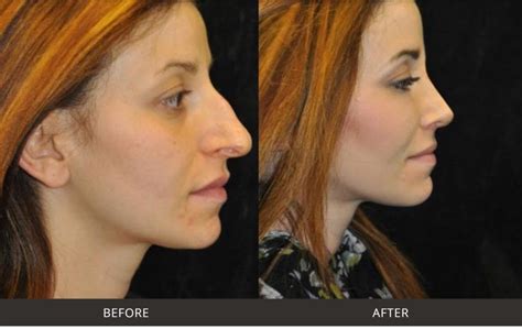 Pin by loubna on Coiffure | Nose job, Nose fillers, Nose plastic surgery