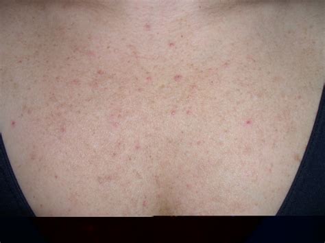 Folliculitis, Pityrosporum (Malassezia Folliculitis) - Dermatology Advisor