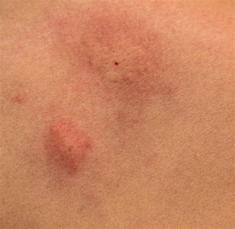 Mosquito Bite Blisters: Causes and Treatment - PestSeek