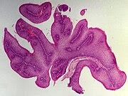 Squamous papilloma of the esophagus - Libre Pathology