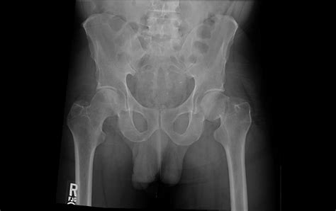 Femoral neck fracture complications - hetytoy