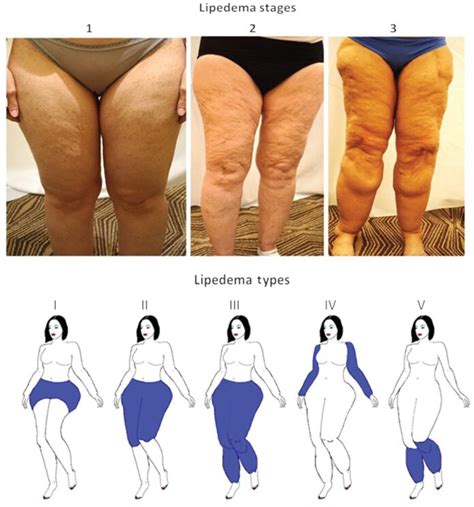 Tratamientos para lipedema - El Men