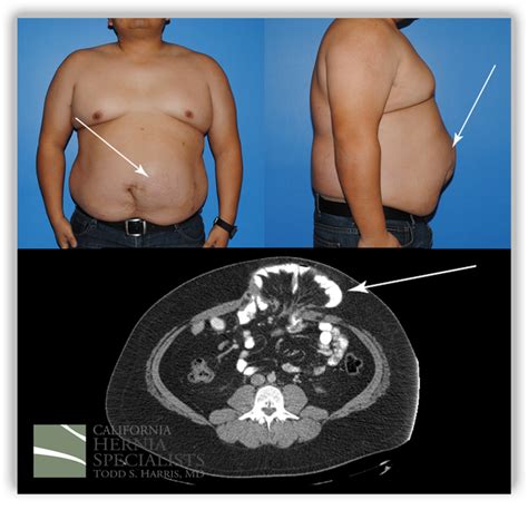 Hernia Types Umbilical