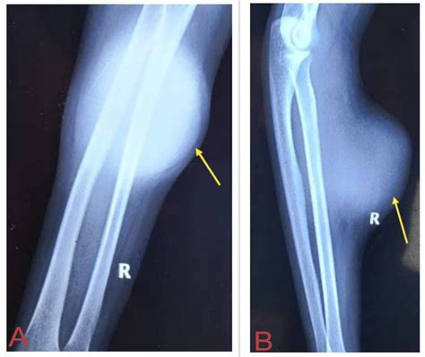 Cureus | Extraosseus Ewing's Sarcoma of the Forearm