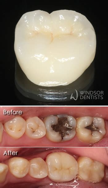 White Porcelain Fillings | Windsor Dentists | North Brisbane