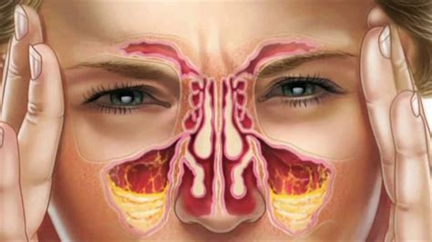 Post Nasal Drip Diagram