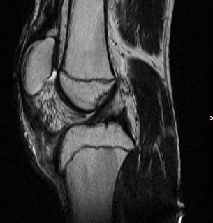 Patellar Tendon Injury-MRI - Sumer's Radiology Blog