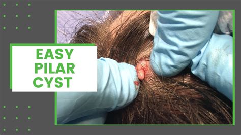 Easy Pilar Cyst | Dr. Derm - YouTube