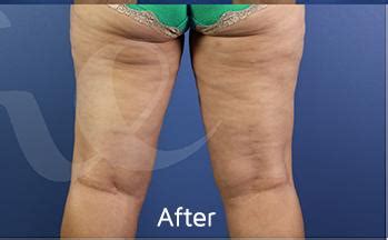 Laser Liposuction Case 7 - Dermatology Clinic New Orleans | Skin Specialists | Etre Cosmetic Derm