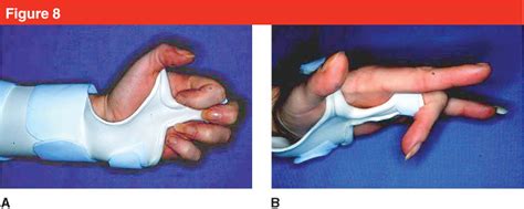 Sagittal Band Rupture Splint