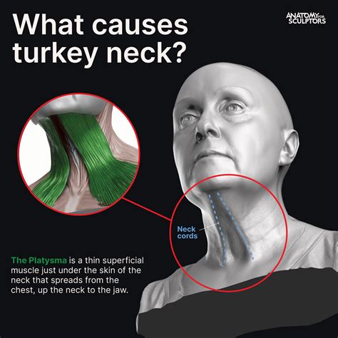 Anatomy For Sculptors - What causes turkey neck?