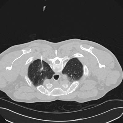 Radiology Cases: 7mm Nodule Lung Biopsy