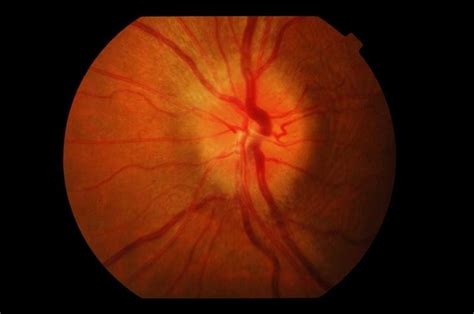 Learn More On What Are The Causes Of Optic Nerve Damage