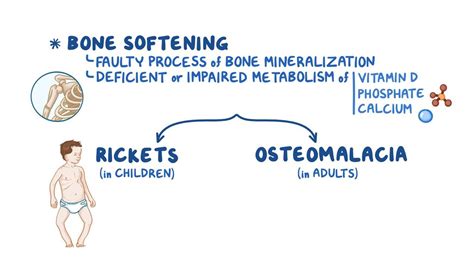 Osteomalacia and rickets: Video, Anatomy & Definition | Osmosis