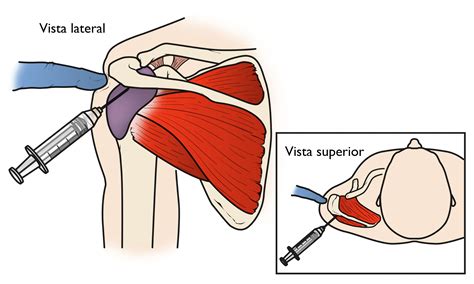 Desgarres del manguito de los rotadores (Rotator Cuff Tears) - OrthoInfo - AAOS