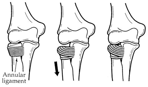 How To Reduce A Nursemaid's Elbow - Warexamination15