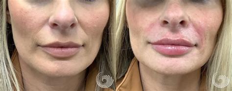 Filler Treatment, before and after – lip augmentation, smile lines