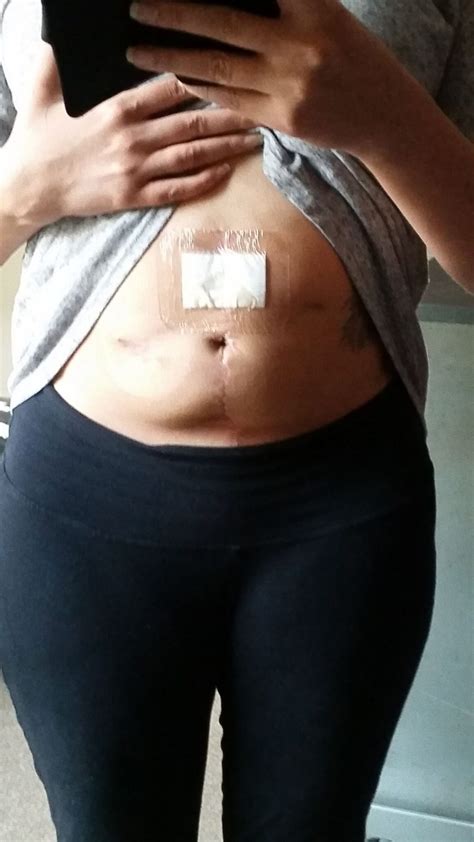 6 Weeks Post Colostomy Reversal Op! I survived!