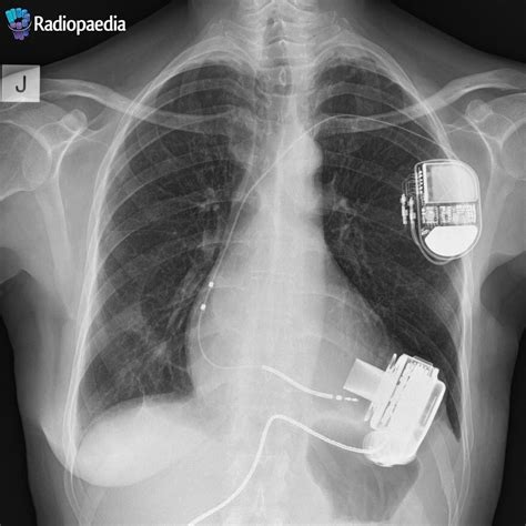 Radiology Signs • A left ventricular assist device (HeartMate 3) is...