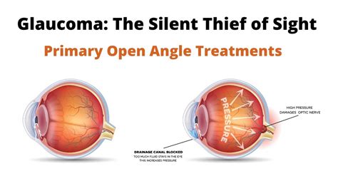 Primary Open Angle Glaucoma