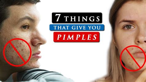 How To Avoid Pimples : Pimples on the chin: What it means and how to ...