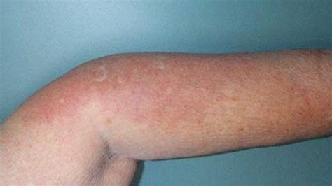 Rheumatoid arthritis rash: Causes, treatment, and images