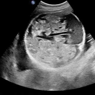 Ultrasound showing the fetal head with no discernable anatomy ...