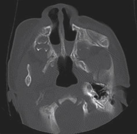 Single-Stage Choanal Atresia Repair in the Neonate | Congenital Defects ...