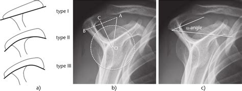 Acromion Types