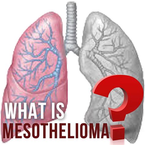 The Fundamentals of Mesothelioma Cancer Lawyer Revealed - Mesothelioma