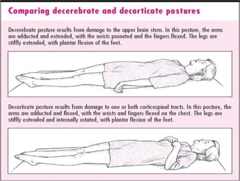 Glasgow Coma Score (GCS) - Dr. Paul Mirdamadi DDS