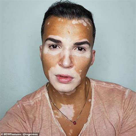 Model with vitiligo says strangers thought condition was contagious - Big World Tale