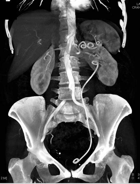 Left Ureteral Stent Within Distal Ureter and not in Bladder - Kidney ...