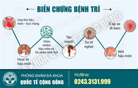 Biểu hiện trĩ ngoại là gì?