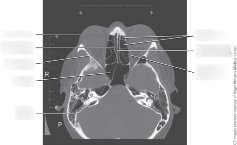 Sectional Anatomy: CT images of the facial bones: AXIAL 8 Diagram | Quizlet