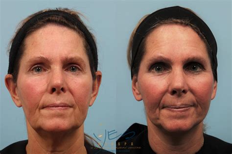 Face Lift & Neck Lift Before & After Photos Patient 201 | Vancouver, BC | YES Medspa & Cosmetic ...