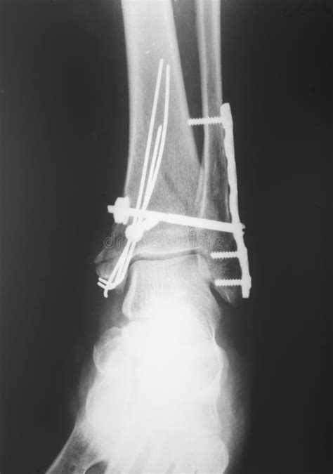 1,338 X Ray Broken Leg Stock Photos - Free & Royalty-Free Stock Photos ...