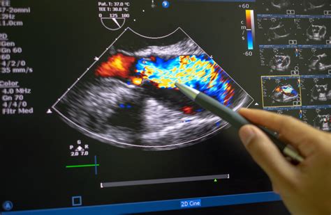 Echocardiography (ultrasound). - Parker University