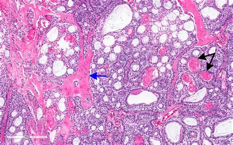 Pathology Outlines - Dentinogenic ghost cell tumor