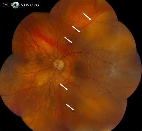 Vitreous Syneresis: An Impending Posterior Vitreous Detachment (PVD)