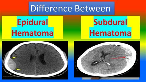 Subdural Hematoma Vs Epidural Hematoma Xray Google Suche Epidural | The ...