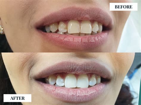 Laser Teeth Whitening To Obtain A Perfect Smile « Stunning Dentistry Blog