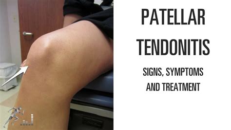 Patellar tendonitis: Signs, symptoms and remedies for this difficult knee problem - YouTube